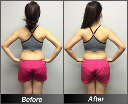 Emily Pham - Before & After Back
